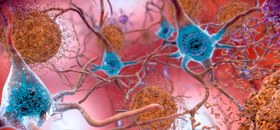 Вирус герпеса может вызвать болезнь Альцгеймера